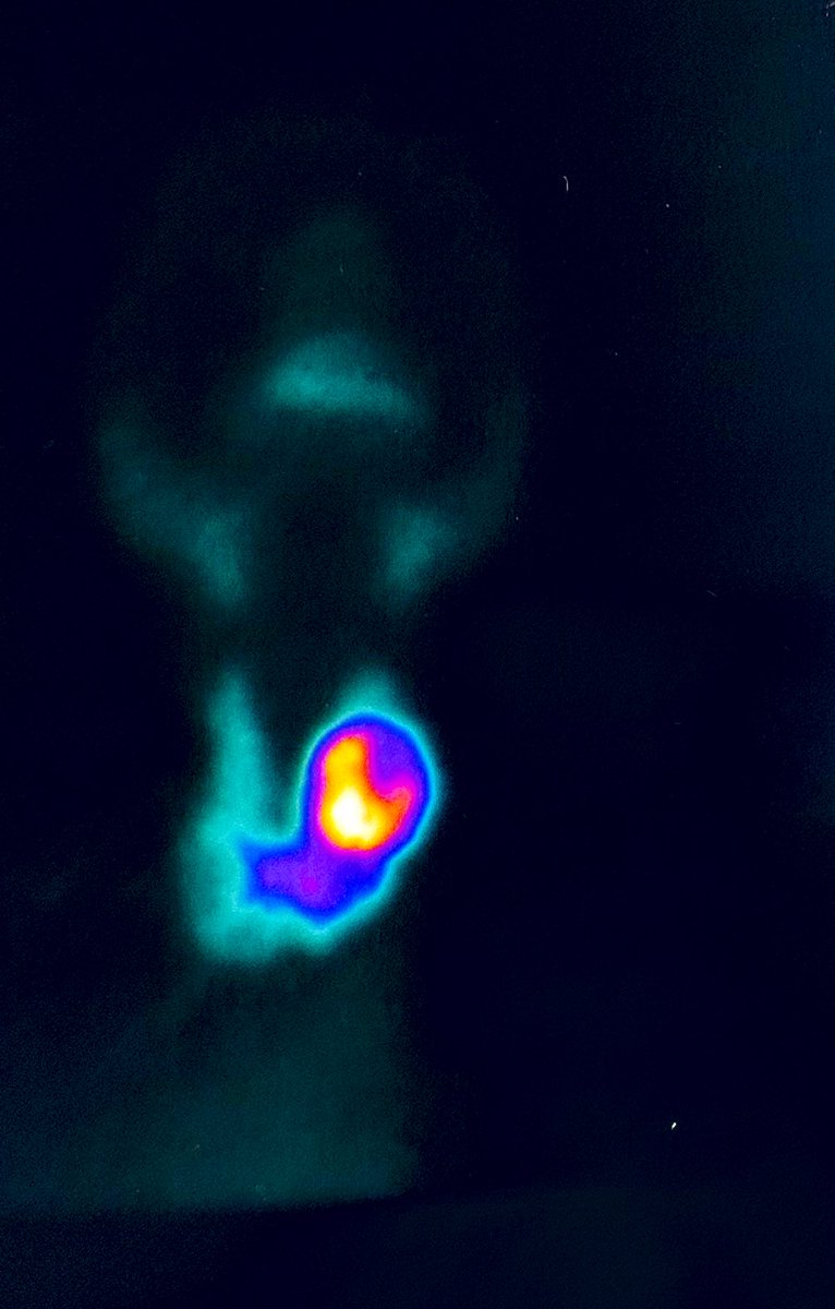 DRNAVNEET83's tweet image. Tc 99m thyroid scan of a patient with thyrotoxicosis. 

Guess the pathology #MedTwitter !! 

#EndoTwitter #MedX
