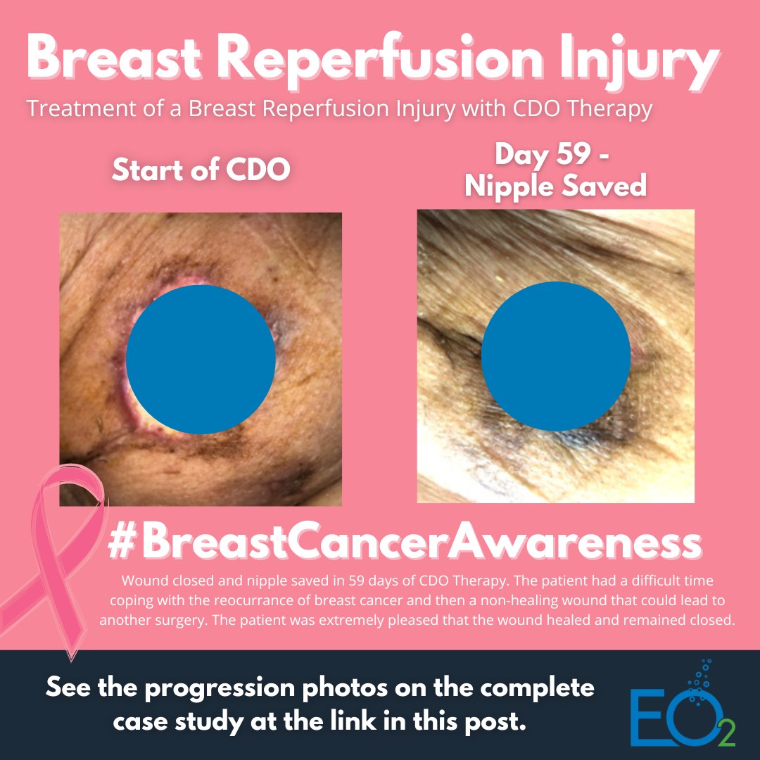 EO2Concepts's tweet photo. Breast Cancer #Survivor with a breast reperfusion injury, saved in 59 days with CDO Therapy.

See the entire case details here: https://t.co/28edR6ezD5
#breastcancerawareness #OCTbreastcancerawarenessmonth #breastcancersurvivor #breastcancerfight https://t.co/rSbrmeKSGx