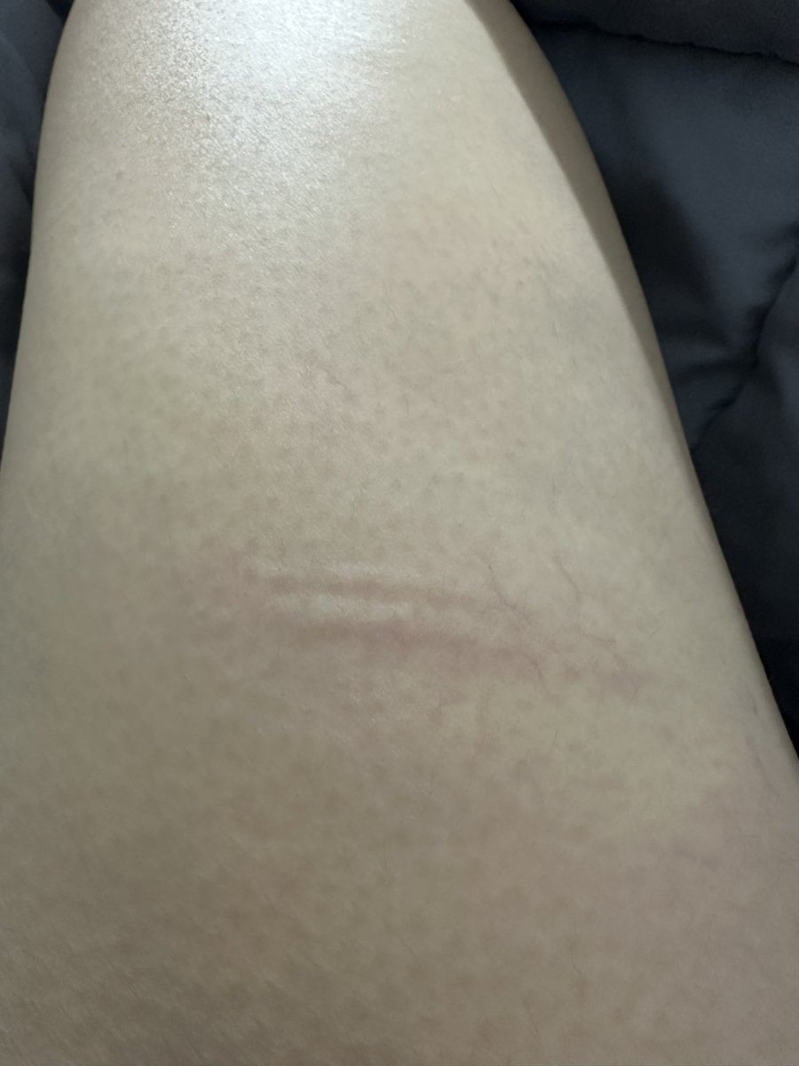 케인 한 대 휘둘렀다고 이렇게..?