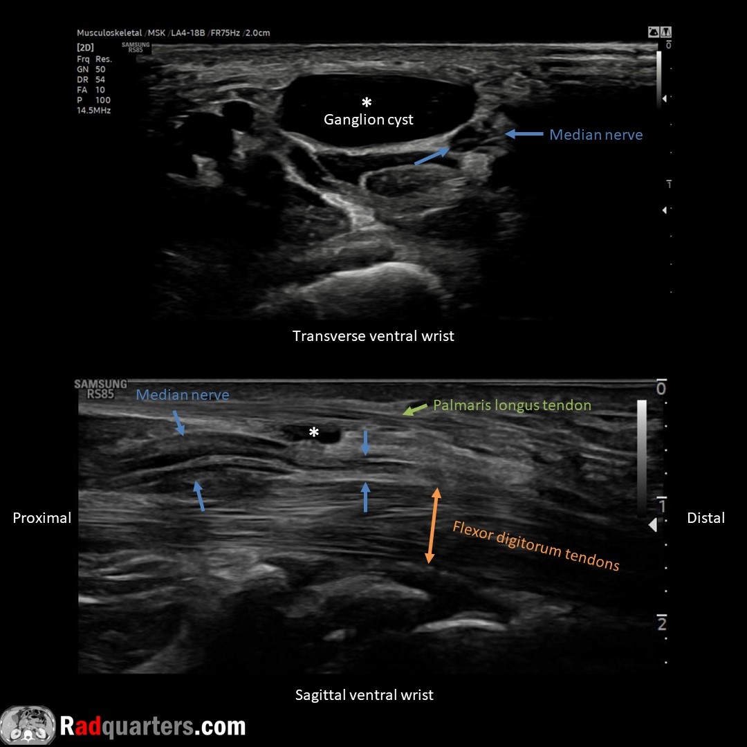 Ventral wrist ganglion cyst causing median nerve compression. MN identified by its fascicular, honeycomb configuration. Thickened nerve proximal to cyst, normal diameter distally = Notch sign. Watch📽️ to learn more: bit.ly/rq-ganglion @BostonImaging @SamsungHealth #FOAMrad