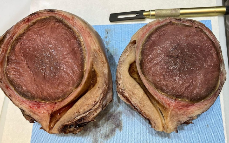 hcabrandonpath's tweet photo. 🔴 A hysterectomy specimen with a large LEIOMYOMA undergoing RED DEGENERATION ‼️ https://t.co/91JV1KuYCa