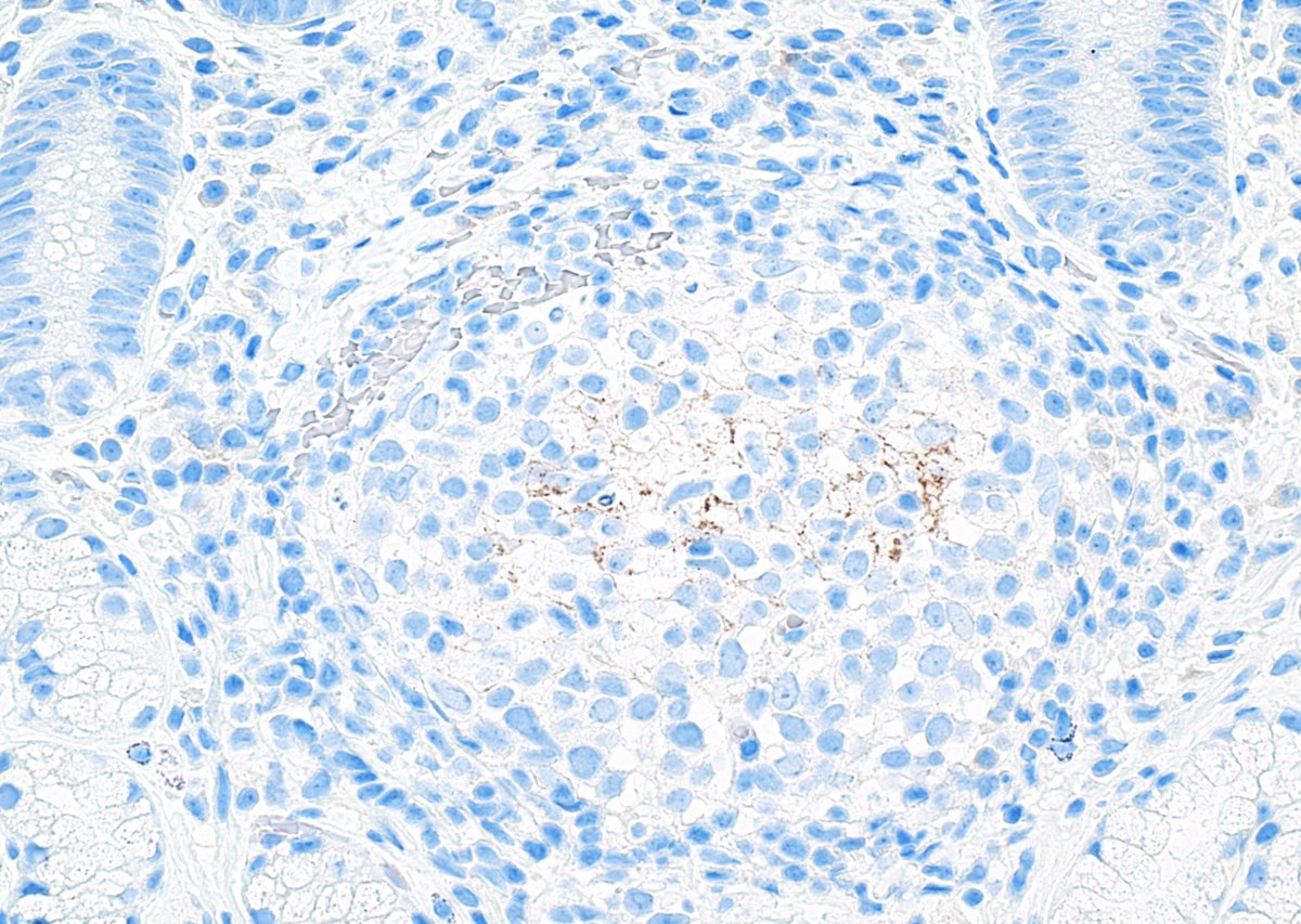 GIJamesMD's tweet image. A cup of ☕️(Starbucks gift card via email) to the first #pathtrainee/#pathresident who correctly identifies the stain and finding in this gastric biopsy.

🚨🚨🚨🚨🚨🚨🚨🚨🚨🚨🚨🚨🚨🚨🚨🚨

#pathmatch2024 #path2path #PathTwitter #GIpath #pathology #MedTwitter #TooCloseToDiagnosis