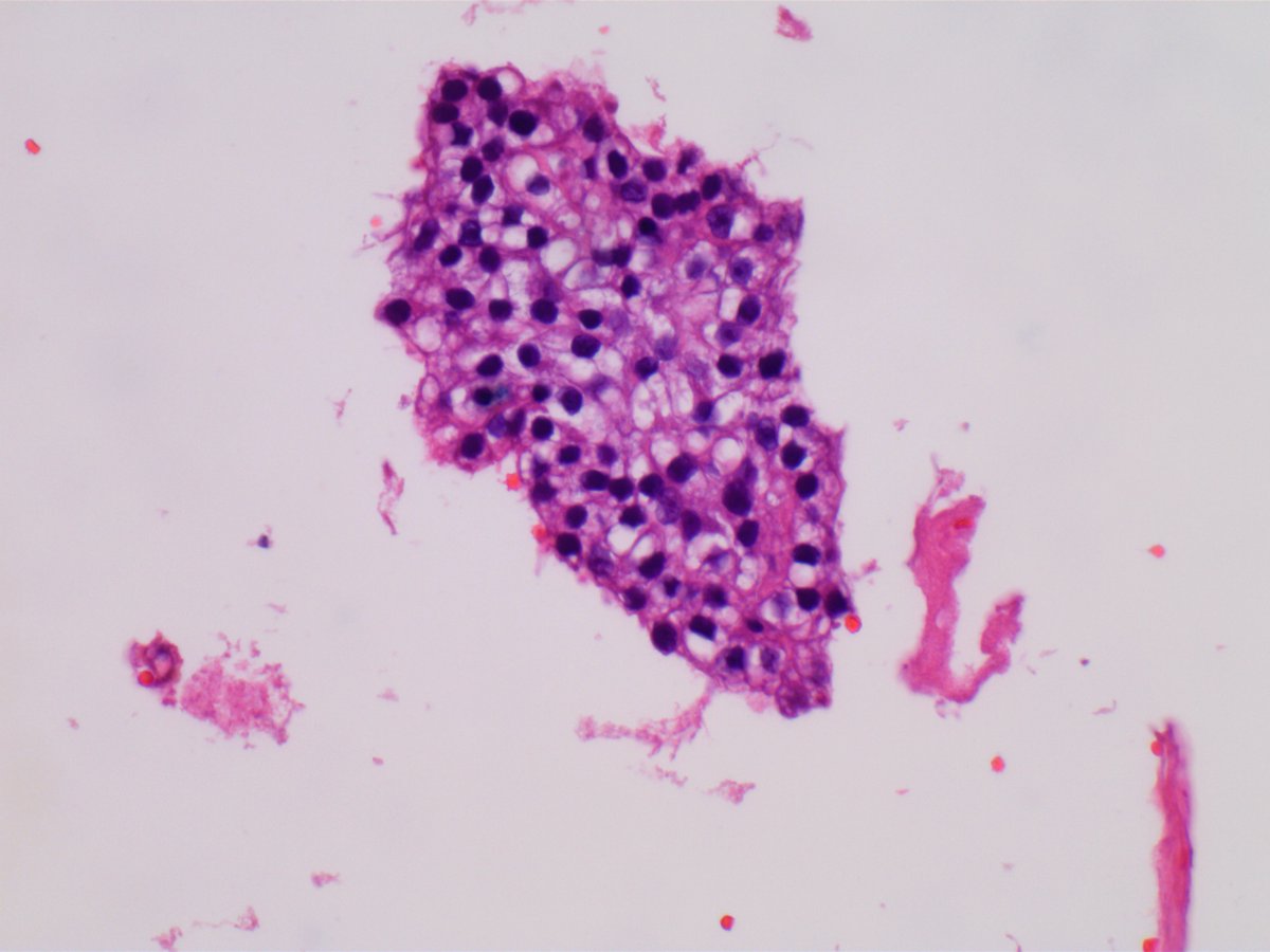 hcabrandonpath's tweet photo. 69 y male, ascitic fluid for cytology

Benign or malignant?

Metastatic renal cell carcinoma, PAX-8+, RCC+, MOC-31-

Bland cytology so history and IHC helped

#pathology #cytopathology #hcaflbrandonpathology

1/2 https://t.co/5D29rYwLaa