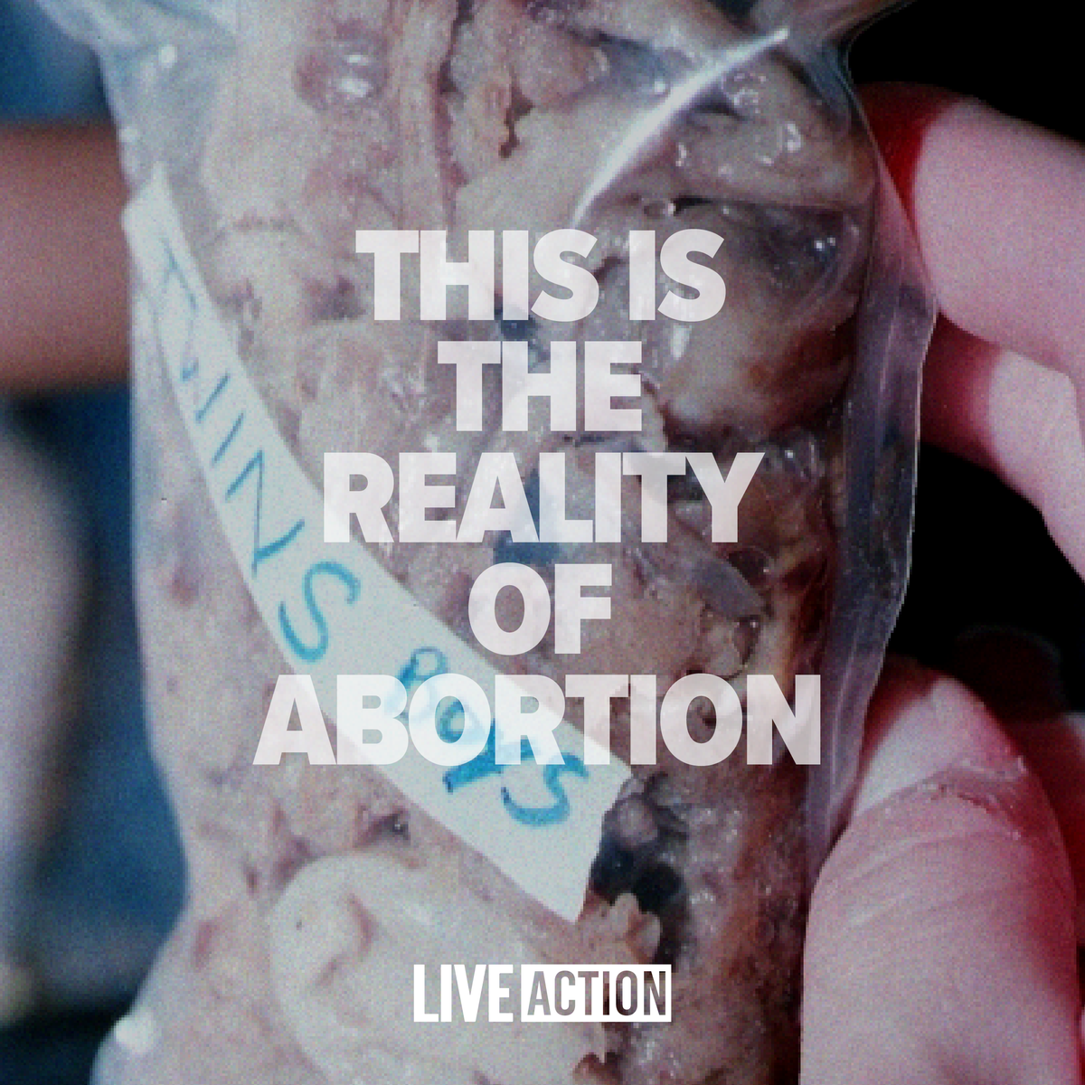 LiveAction's tweet photo. This is the reality of abortion.

Twin boys stuffed in a plastic bag - their bodies torn apart and mixed together.

They should have grown up together in a loving family, sharing bunk beds, and playing catch. Instead, they experienced inhuman cruelty as they were dismembered with cold metal forceps and thrown away like trash.

We don't know why they were killed, but no circumstance could ever justify their deaths.

Let these little boys motivate you to protect every child and end abortion NOW.