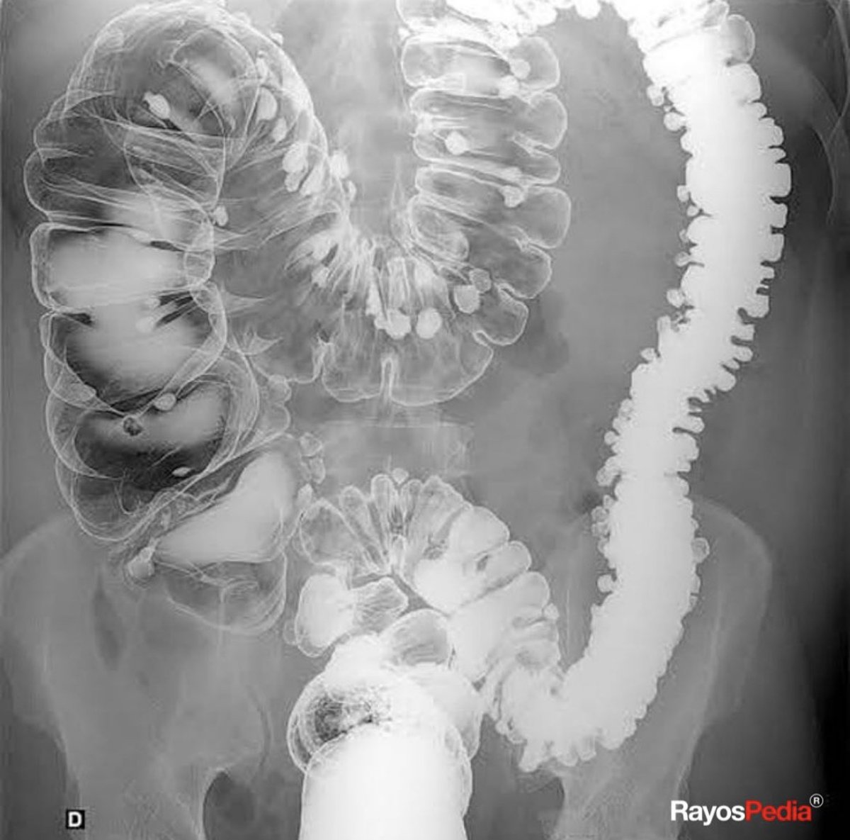 A beautiful image of the colon. What’s the diagnosis?