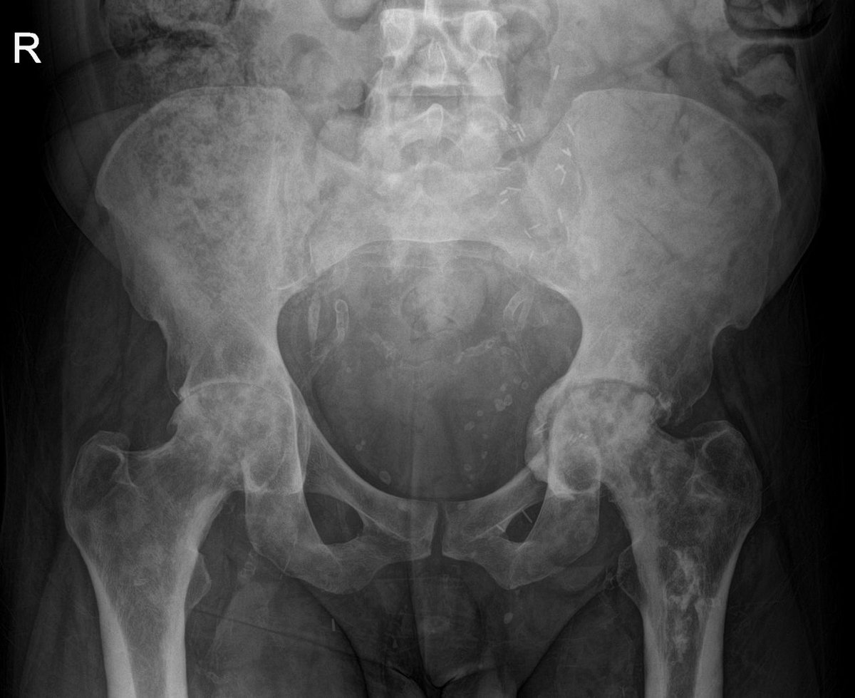 (๐๐๐๐ก๐๐๐ข๐๐๐๐๐๐) (@drvikasshah) on Twitter photo I mentored future radiologist Dr Niharika Praveen to publish this case on @radiopaedia
โ Can you work out what background disease this person has?
โ Which complications have arisen?
Full answer over weekend with link to case (w/ stacks & annotations) I mentored future radiologist Dr Niharika Praveen to publish this case on @radiopaedia
โ Can you work out what background disease this person has?
โ Which complications have arisen?
Full answer over weekend with link to case (w/ stacks & annotations)