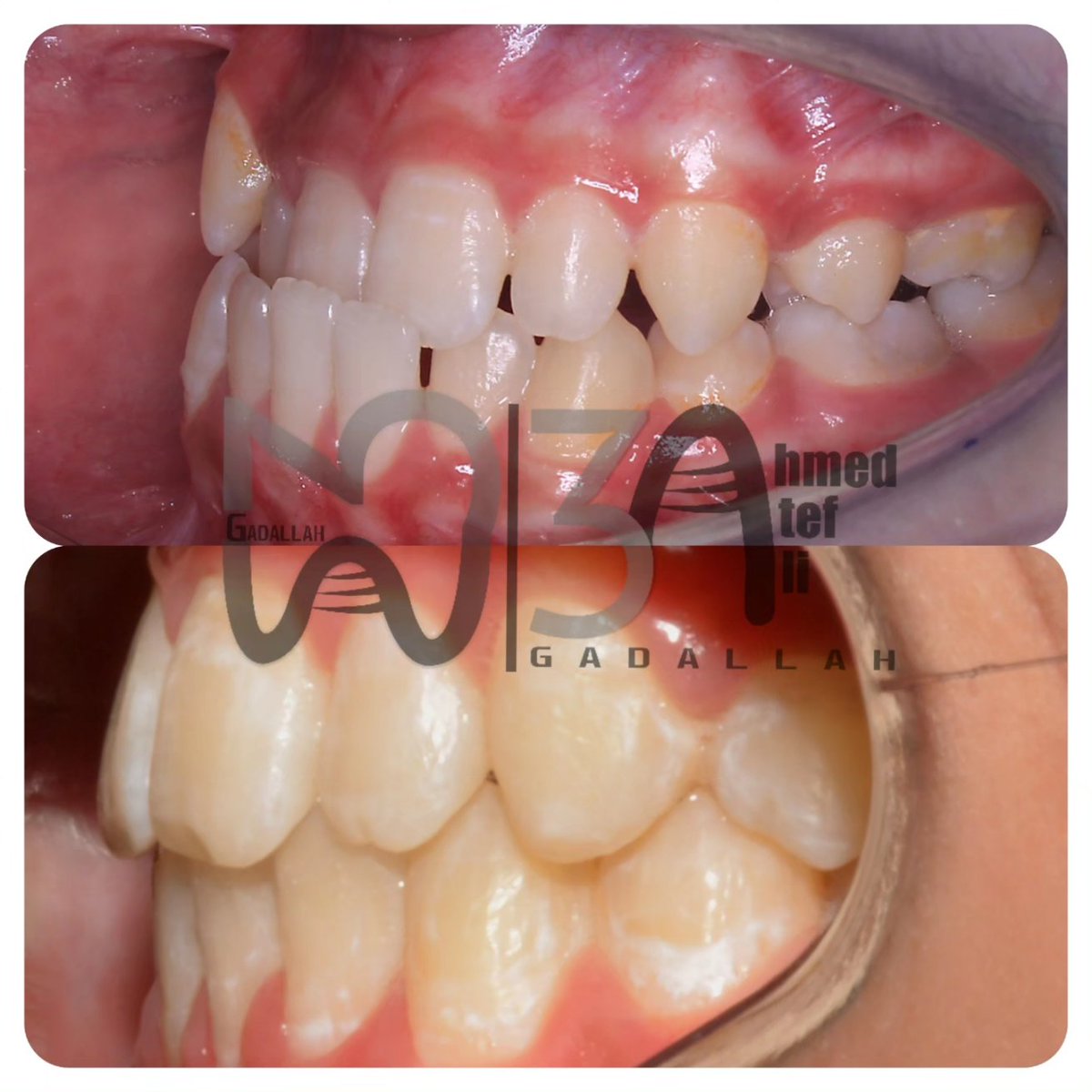 تم العلاج في 8 شهور
( بصوت انور السادات)
The power of orthodontics 💪💪