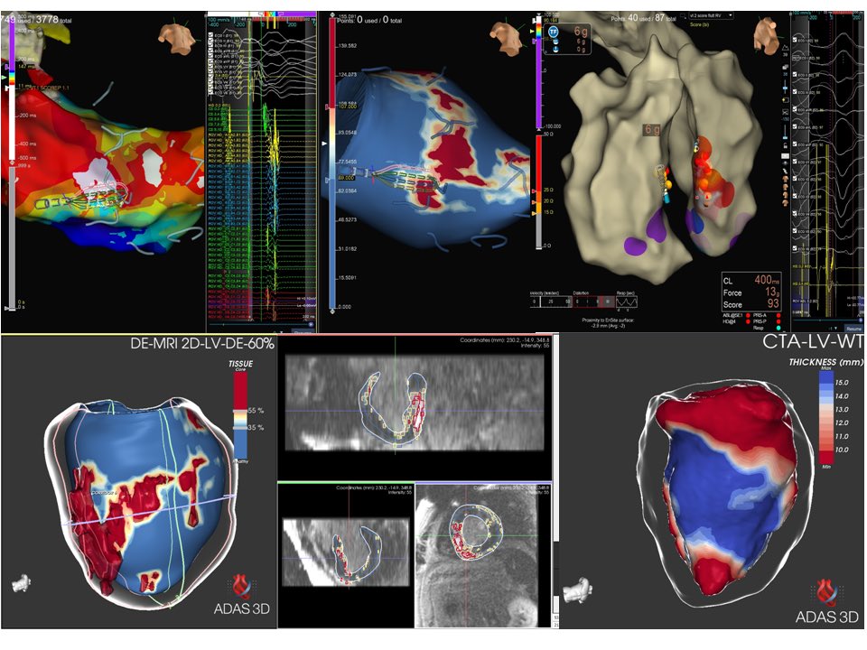 ivroca's tweet photo. A pleasure to have received colleagues from Poland x 2-day workshop in @hospitalclinic for live cases. Today CNA by @aportasanchez and @MargaridaPujol. Yesterday HCM VT by @TillAlthoff and myself. DZ in septal channel requiring bipolar RF (20 mm septum).@laiallorca1 @JuditMasC_ https://t.co/AxtHvkFZIB