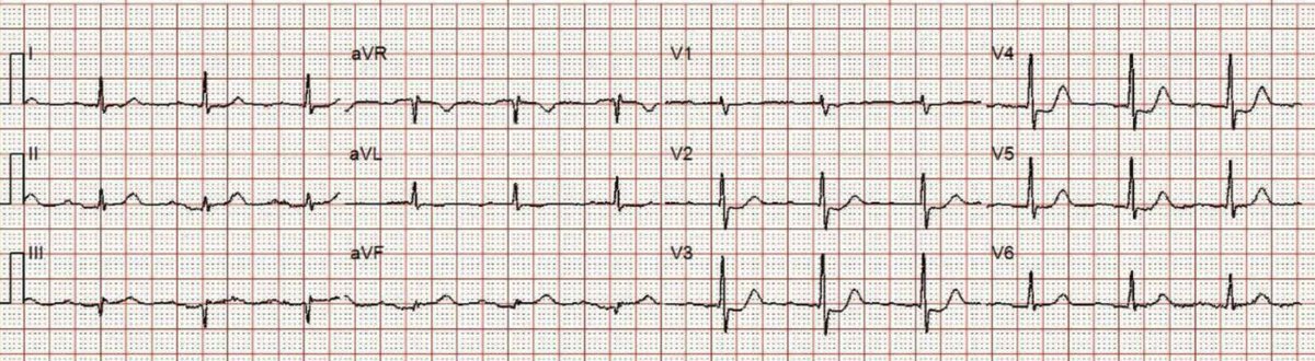 What is the infarct artery? What does the post PCI ECG show? What does the convalescent ECG show? hqmeded-ecg.blogspot.com/2023/10/what-i…