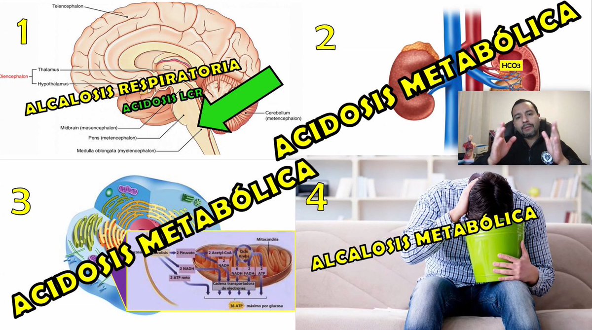MUE_USS's tweet photo. Dr Astorga nos habla de Intoxicación por Salicilatos⚠️cuadro clínico poco frecuente, pero letal si no se piensa a tiempo ni se maneja de forma adecuada1️⃣Enfrentamiento estructurado paciente indiferenciado2️⃣no olvidar diferenciales3️⃣una vez identificado el cuadro=tto específico🔜 https://t.co/iFRvIOzfmd