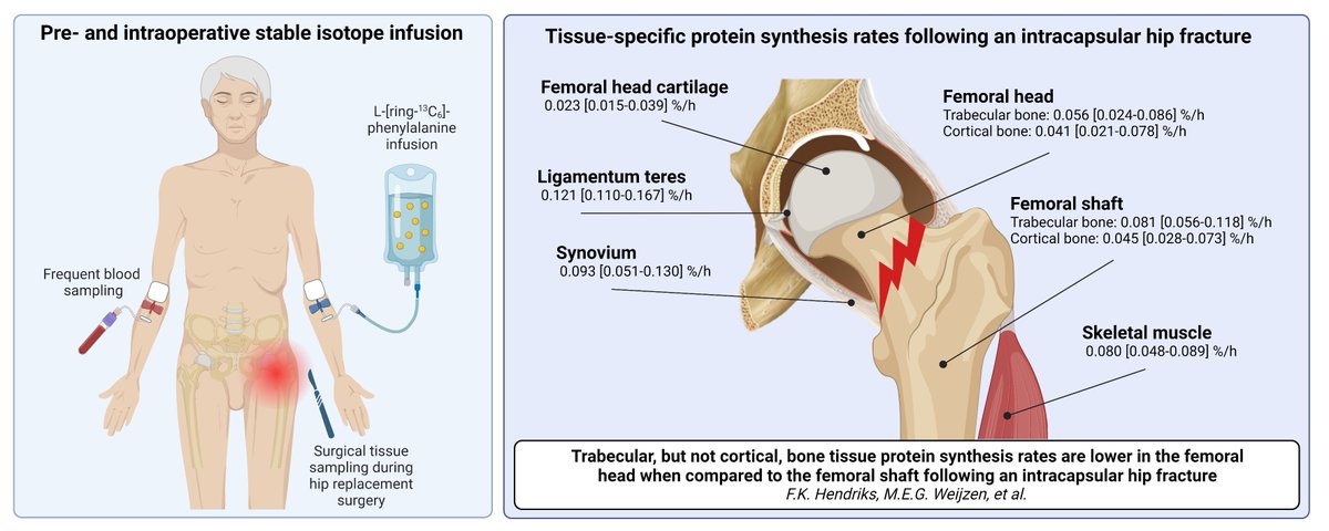 Floris Hendriks (@hendriks_fk) on Twitter photo Happy to have this one published with <a href="/michelleweijzen/">Michelle Weijzen</a>!
Together we managed to start tracer infusion in the short period between admission and surgery of patients with a hip fracture and assess bone protein synthesis proximal and distal of the fracture🦴
bitly.ws/WEwq Happy to have this one published with <a href="/michelleweijzen/">Michelle Weijzen</a>!
Together we managed to start tracer infusion in the short period between admission and surgery of patients with a hip fracture and assess bone protein synthesis proximal and distal of the fracture🦴
bitly.ws/WEwq