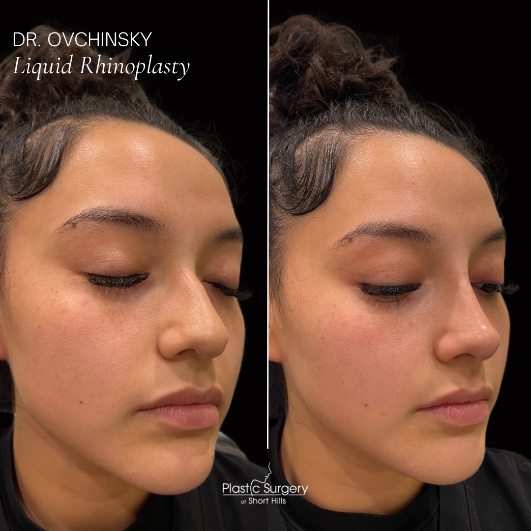 DrOvchinsky's tweet photo. Liquid Rhinoplasty ✨MAGIC ✨Can you believe her nose was transformed in just minutes?! That’s right, a liquid rhinoplasty brings instant results as our expert injector Dr. Ovchinsky strategically injects dermal fillers into certain areas of the nose to achieve an improved shape! https://t.co/ytIYiPM0gh