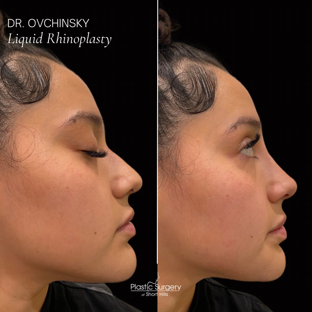DrOvchinsky's tweet photo. Liquid Rhinoplasty ✨MAGIC ✨Can you believe her nose was transformed in just minutes?! That’s right, a liquid rhinoplasty brings instant results as our expert injector Dr. Ovchinsky strategically injects dermal fillers into certain areas of the nose to achieve an improved shape! https://t.co/ytIYiPM0gh