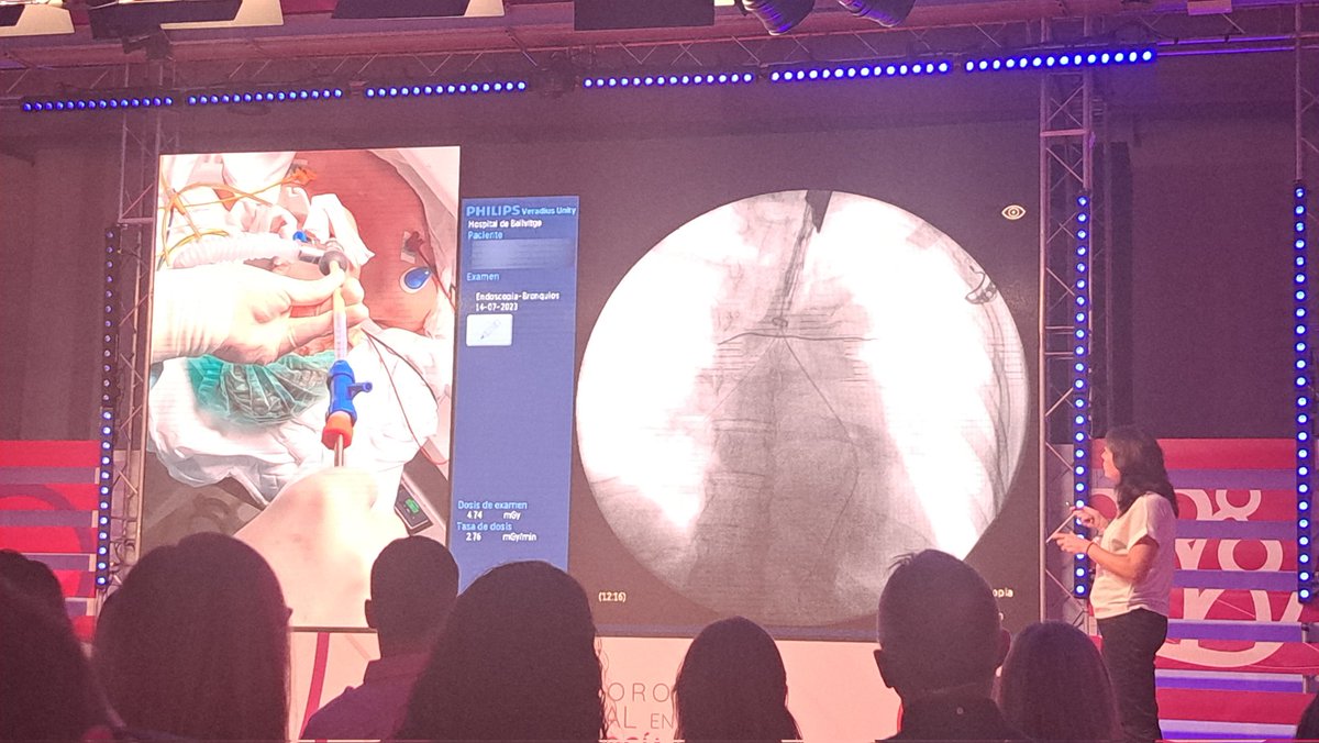 Increíble ponencia de la Dra. López-Lisboa, con un caso de uso del láser de diodo y posterior colocación de prótesis en carina 
#videoforoneumología