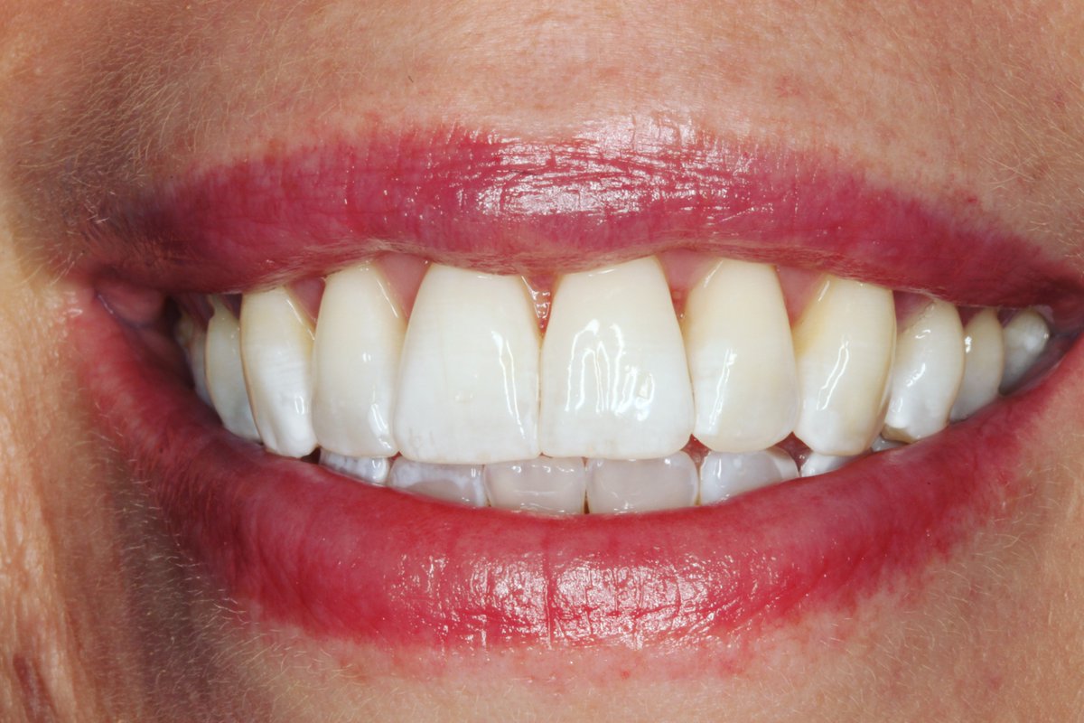 ConfidentOrtho's tweet photo. ✨ Charlotte's smile? From lovely to luminous! 🦷✨ Impressive whitening results! Thinking of a smile upgrade? 📞 01823 289276. We're here for all your whitening queries and bookings! ⭐️ #BrighterSmileAhead https://t.co/dVmWyeY0qg