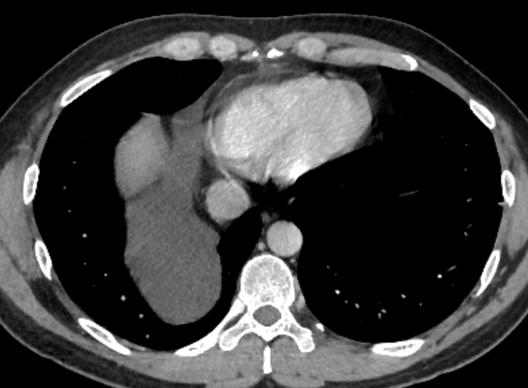 🔵Abdominal pain 🟢Incidental finding 🟣Pretty frequent anterior mediastinal lesion with a not so frequent posterior extention🙄 What do you think?🤔 #FOAMrad #Chestrad #radtwitter
