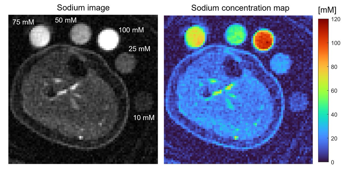 Rebecca Rose Baker (@rebeccarbaker29) on Twitter photo Did you know, hydrogen isn't the only nucleus that can be seen with an #MRI scanner? Sodium MRI🧲can be used to measure sodium🧂concentrations in muscle and skin. Check out sodium imaging of the calf in my newest paper📰out today!! <a href="/MagResMed/">Magn Res Medicine</a> onlinelibrary.wiley.com/doi/10.1002/mr… <a href="/UCL_ICS/">UCL Institute of Cardiovascular Science</a> #UCL Did you know, hydrogen isn't the only nucleus that can be seen with an #MRI scanner? Sodium MRI🧲can be used to measure sodium🧂concentrations in muscle and skin. Check out sodium imaging of the calf in my newest paper📰out today!! <a href="/MagResMed/">Magn Res Medicine</a> onlinelibrary.wiley.com/doi/10.1002/mr… <a href="/UCL_ICS/">UCL Institute of Cardiovascular Science</a> #UCL
