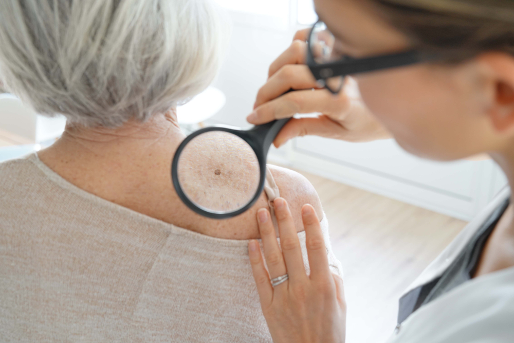 As the most common type of cancer in the United States, skin cancer affects 1 in 5 people before the age of 70. To know what to lookout for, keep in mind the following early warning signs of skin cancer, which are easier to remember using the acronym ABCDE bit.ly/3RKQmmj