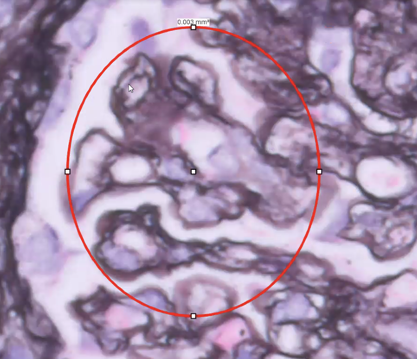 ssfarouk's tweet image. Double contours in a #kidneytransplant with transplant glomerulopathy #kidneypath 🛤️