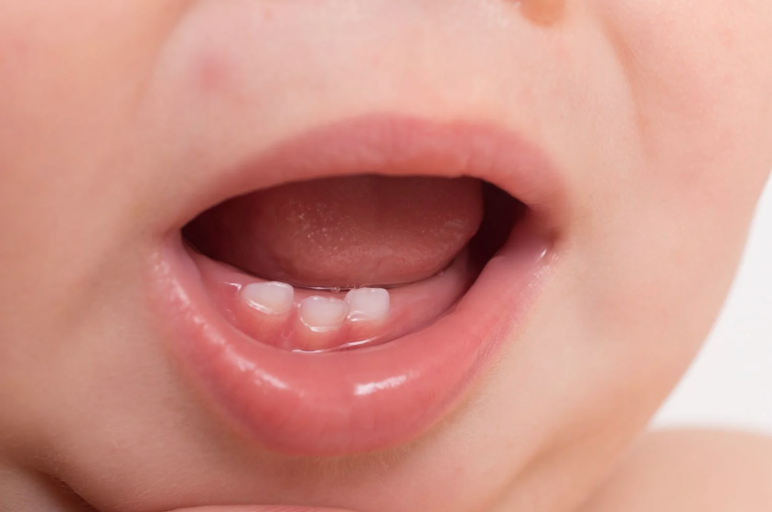 Laser Tongue and Lip Tie Correction - what is it? dentist-alderley-newmarket.com.au/services/laser… #liptie #tonguetie #brisbane