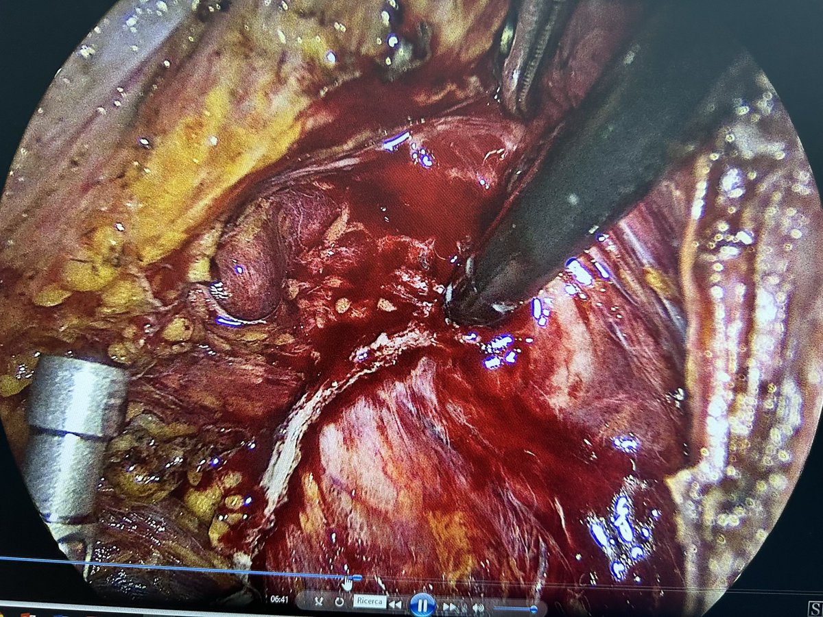 Stapler misfire during low colorectal anastomosis: the nightmare of every surgeon. WWYD?