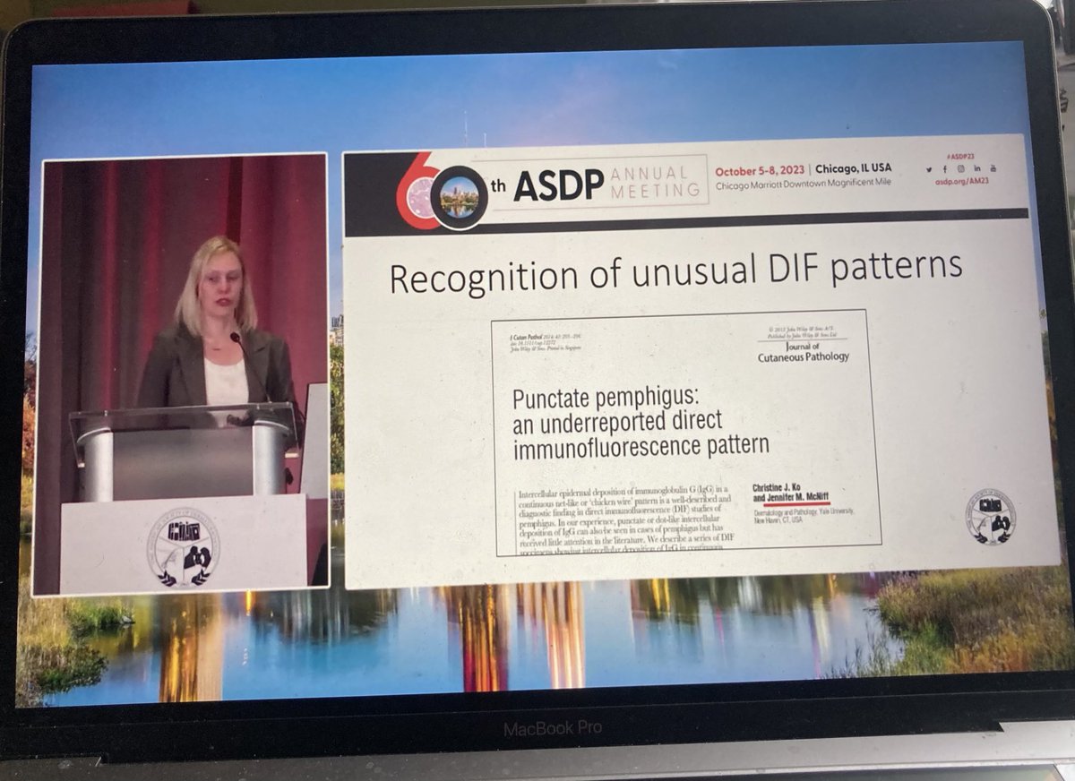 Dermpathl's tweet photo. Recognition of unusual direct immunofluorescence (DIF) patterns. Punctate pemphigus and fibrillary IgA deposition in dermatitis herpetiformis. Dr. @JuliaSLehmanMD, Short Course II, #ASDP23 #dermpath #pathology #immunopath https://t.co/5uLCLKTZQN