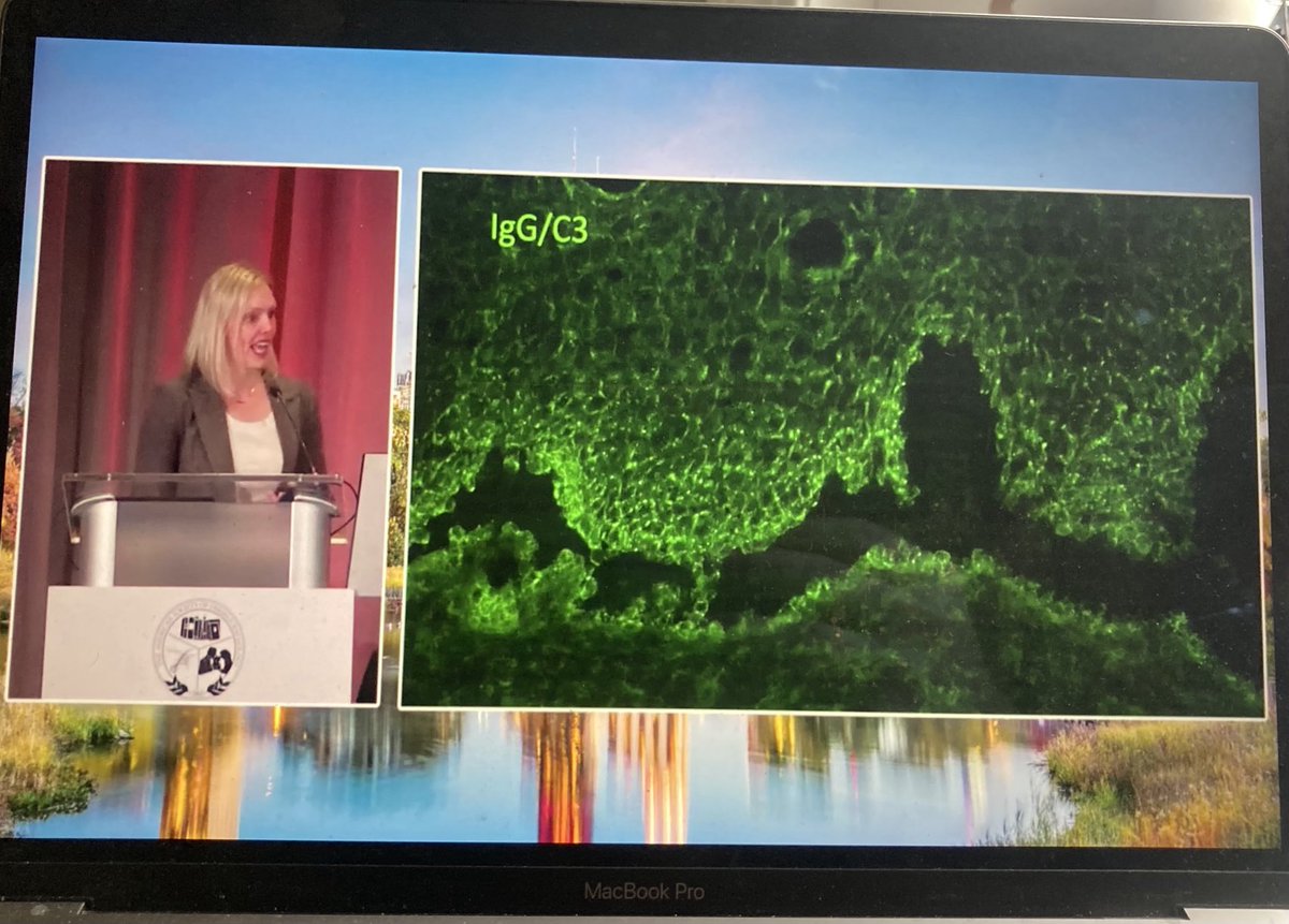 Dermpathl's tweet photo. Recognition of unusual direct immunofluorescence (DIF) patterns. Punctate pemphigus and fibrillary IgA deposition in dermatitis herpetiformis. Dr. @JuliaSLehmanMD, Short Course II, #ASDP23 #dermpath #pathology #immunopath https://t.co/5uLCLKTZQN