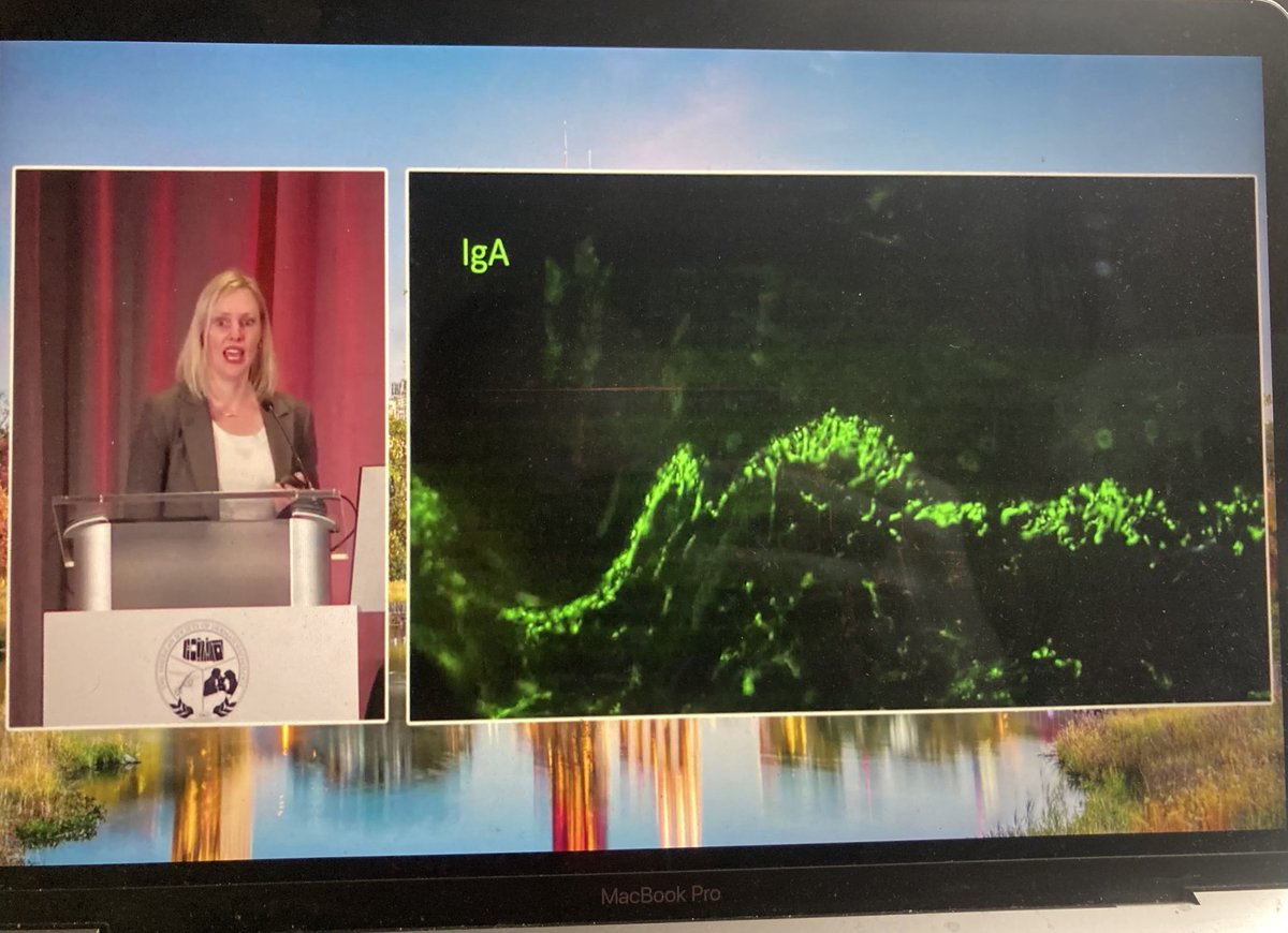 Dermpathl's tweet photo. Recognition of unusual direct immunofluorescence (DIF) patterns. Punctate pemphigus and fibrillary IgA deposition in dermatitis herpetiformis. Dr. @JuliaSLehmanMD, Short Course II, #ASDP23 #dermpath #pathology #immunopath https://t.co/5uLCLKTZQN