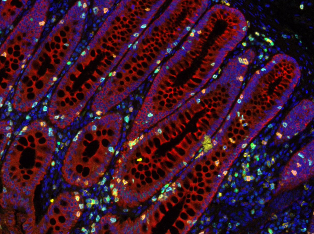 ONJ Cancer Research Institute (@onjcri) on Twitter photo 🥳 Excited to announce new #onjcri <a href="/ScIimmunology/">Science Immunology</a> publication – 5 years in the making from <a href="/Mielke_Lisa/">Lisa Mielke</a> & team (<a href="/MarinaYakou/">Marina Yakou</a> <a href="/Sonia_Ghi/">Gh_So</a> Kelly Tran).
World-first discovery: Targeted deletion of TCF-1 on gamma delta T cells reduced #bowelcancer tumours
bit.ly/3LMY8bC 🥳 Excited to announce new #onjcri <a href="/ScIimmunology/">Science Immunology</a> publication – 5 years in the making from <a href="/Mielke_Lisa/">Lisa Mielke</a> & team (<a href="/MarinaYakou/">Marina Yakou</a> <a href="/Sonia_Ghi/">Gh_So</a> Kelly Tran).
World-first discovery: Targeted deletion of TCF-1 on gamma delta T cells reduced #bowelcancer tumours
bit.ly/3LMY8bC