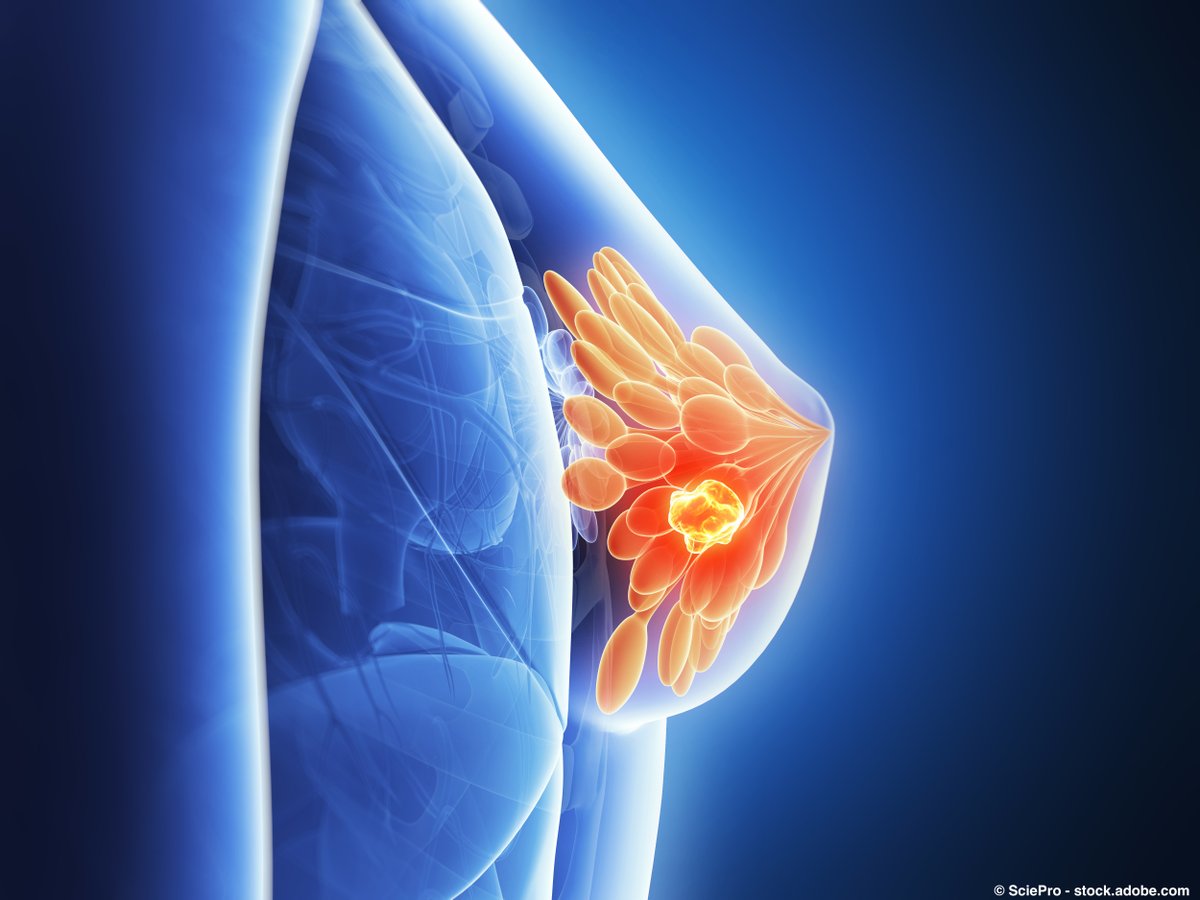 OncLive.com (@onclive) on Twitter photo Findings showed that at a median follow-up of 21.5 months, patients treated in the 34 Gy cohort experienced a pCR/nCR rate of 93.3% vs 37.5% in patients treated in the 30 Gy cohort. <a href="/AsalRahimiMD/">Asal Rahimi M.D., M.S.</a> <a href="/utswcancer/">UTSW Simmons Cancer Center</a> <a href="/ASTRO_org/">ASTRO</a> #ASTRO23 #bcsm onclive.com/view/preoperat… Findings showed that at a median follow-up of 21.5 months, patients treated in the 34 Gy cohort experienced a pCR/nCR rate of 93.3% vs 37.5% in patients treated in the 30 Gy cohort. <a href="/AsalRahimiMD/">Asal Rahimi M.D., M.S.</a> <a href="/utswcancer/">UTSW Simmons Cancer Center</a> <a href="/ASTRO_org/">ASTRO</a> #ASTRO23 #bcsm onclive.com/view/preoperat…
