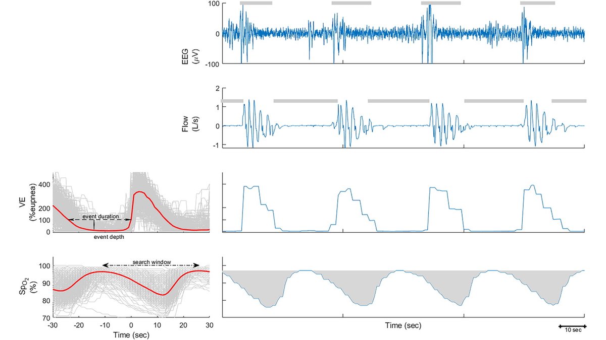 Sleep Apnea Physiological Burdens and Cardiovascular Morbidity and Mortality

🔗 bit.ly/3LHg6MA