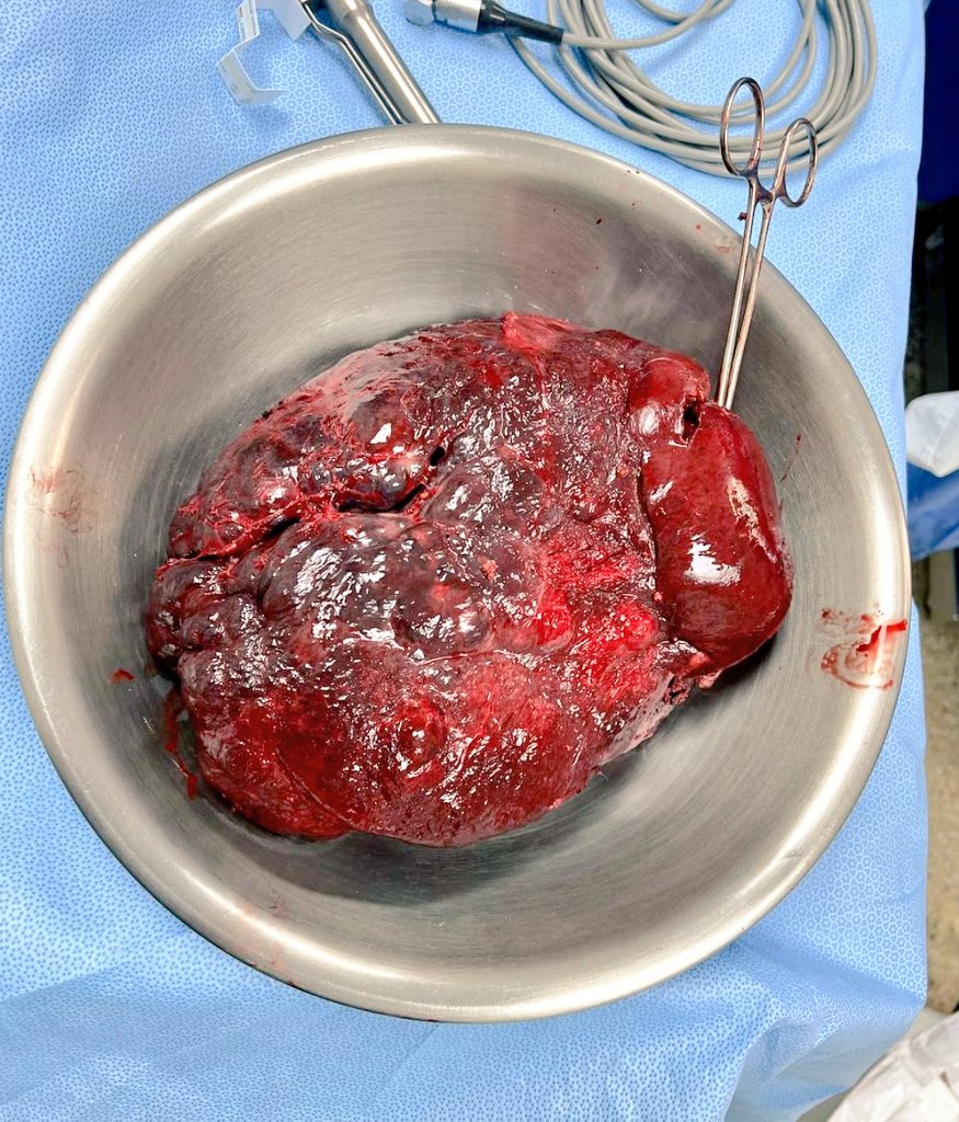 jlberistain's tweet photo. Right extended hepatectomy for a giant hemangioma (a very symptomatic one)

What are your tips &amp; tricks on these type of cases?

@SAGES_Updates
@IHPBA
@AHPBA @VautheyMD 
@santiazagra @me4_so @Some4SurgeryIT1 @hpb_so @cirugiaHPBTLaFe @dr_memeor @addeo_pietro @Bham_HPB_LTx @JSHBPS https://t.co/PlmKZCiVN6