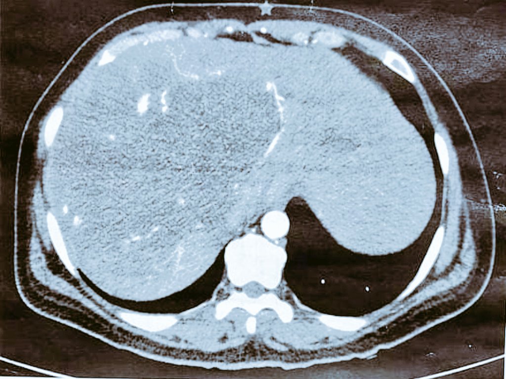 jlberistain's tweet photo. Right extended hepatectomy for a giant hemangioma (a very symptomatic one)

What are your tips &amp; tricks on these type of cases?

@SAGES_Updates
@IHPBA
@AHPBA @VautheyMD 
@santiazagra @me4_so @Some4SurgeryIT1 @hpb_so @cirugiaHPBTLaFe @dr_memeor @addeo_pietro @Bham_HPB_LTx @JSHBPS https://t.co/PlmKZCiVN6
