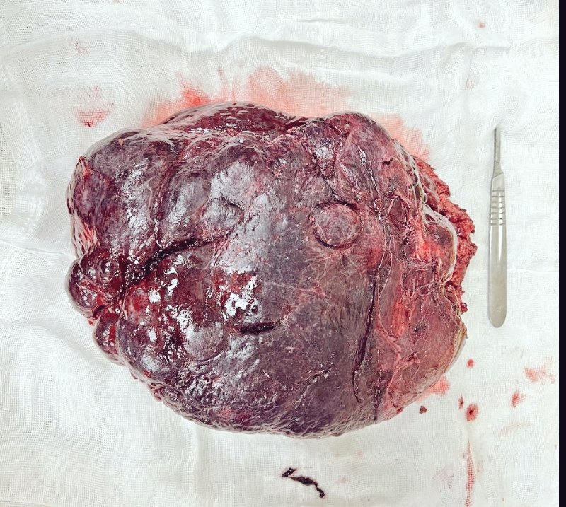 jlberistain's tweet photo. Right extended hepatectomy for a giant hemangioma (a very symptomatic one)

What are your tips &amp; tricks on these type of cases?

@SAGES_Updates
@IHPBA
@AHPBA @VautheyMD 
@santiazagra @me4_so @Some4SurgeryIT1 @hpb_so @cirugiaHPBTLaFe @dr_memeor @addeo_pietro @Bham_HPB_LTx @JSHBPS https://t.co/PlmKZCiVN6