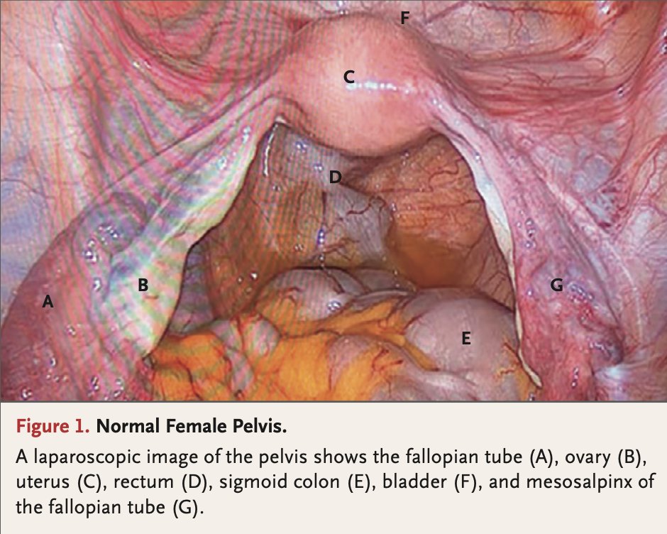 OlgaTheOBGYN's tweet photo. Yo - just a reminder what the normal female pelvis looks like. Review, send around. Sharing is caring #medtwitter #OBGYNtwitter https://t.co/MfGEZBQvrd