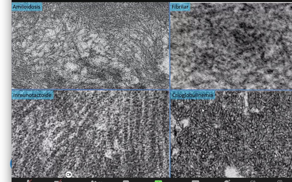 PepaSolerR's tweet photo. @franciscopgonc @shbermejo @NefrologiaVH @DiazFranjdc @GlomConILA Yes,,, onconephrology and its #renalpathology @GlomCon @GlomConILA https://t.co/o8yqcLldTh