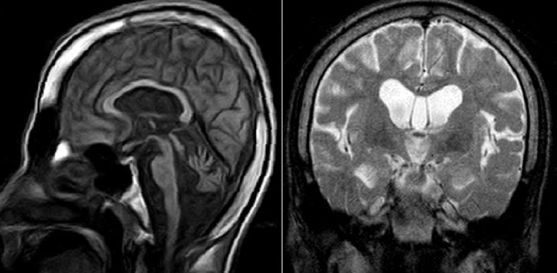 17 year old male with short stature, retinal atrophy and sensorineural hearing loss.

#radres #FOAMrad #RadEd #neurology #Neurosurgery