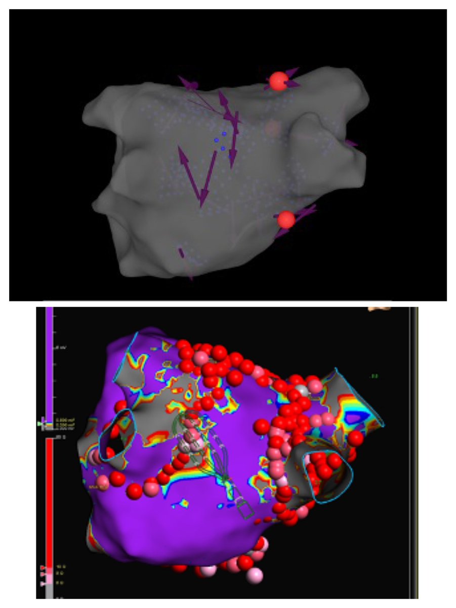 Very excited to use AI powered STAR Apollo AF mapping system during a persistent AF case. 3 sites of interest identified by STAR, 2nd site terminated AF to AT to SR and all three sites included in the PVIs/roof line so minimal post PVI ablation to achieve SR with #EnsiteX…