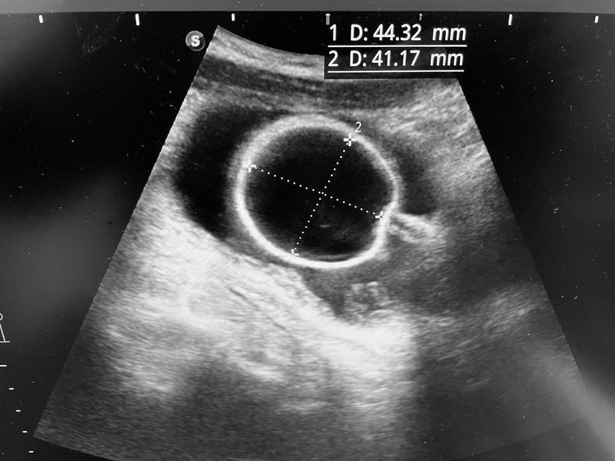 UrologoEdgar's tweet image. Una Foley retenida Constituye un problema una técnicas es inflar el globo hasta reventarlo, idealmente hay que hacerlo con control USG  para verificar que no queden fragmentos de látex en el interior de la vejiga, y formación de Piedras 
#urologia #urology #urotips