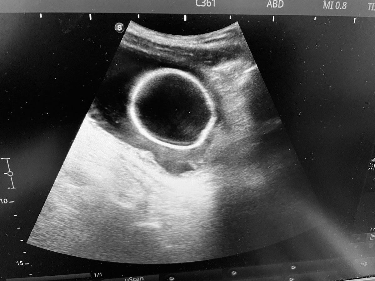 UrologoEdgar's tweet image. Una Foley retenida Constituye un problema una técnicas es inflar el globo hasta reventarlo, idealmente hay que hacerlo con control USG  para verificar que no queden fragmentos de látex en el interior de la vejiga, y formación de Piedras 
#urologia #urology #urotips