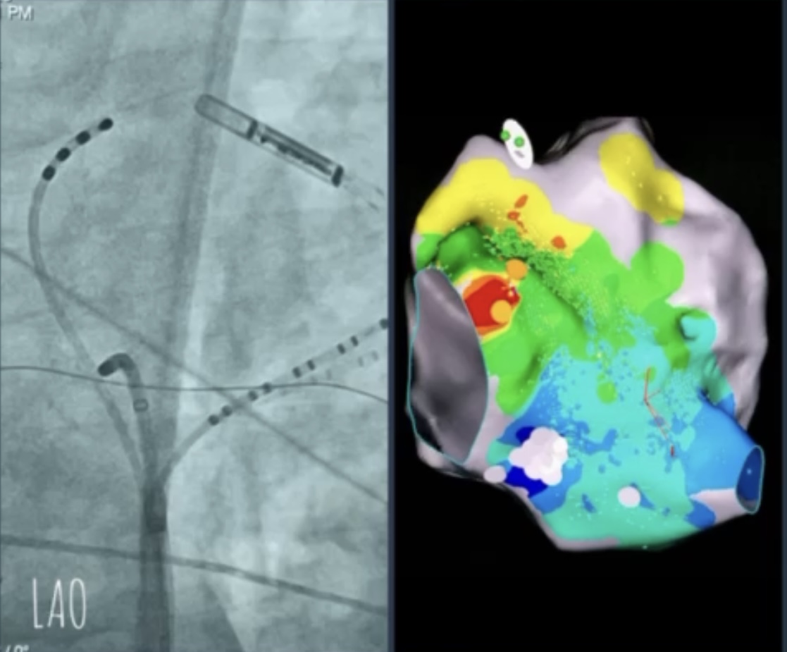 Redo AVNRT case from another center. Pay attention at the slow pathway location in LAO view at the successful ablation site. Impossible to ablate without ILAM of the slow pathway. @ipetemil @athsaplaouras @SteliosDragasis @MEfraimidis #EPeeps #OnassisCardiacSurgeryCenter