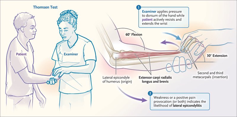 Tennis Elbow (Lateral Epicondylitis)

▪️usually resolves in 6-12 months
▪️no strong evidence to support any intervention
▪️Physiotherapy👉🏾limited evidence
▪️Steroid injections👉🏾short term pain relief (long-term adverse effects)
▪️Surgery👉🏾rarely indicated

nejm.org/doi/full/10.10…