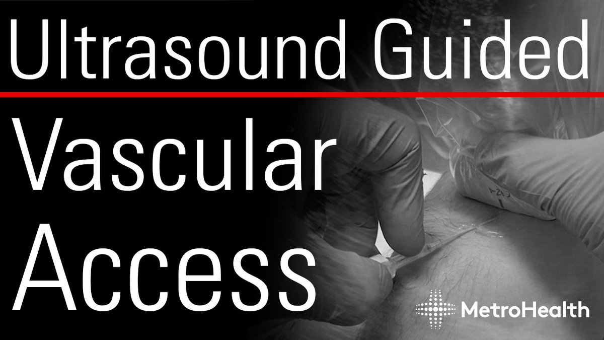 MetroHealth Emergency Ultrasound (@mh_emultrasound) on Twitter photo Check out our latest video by <a href="/mtabbut/">Matt Tabbut, MD</a> about Ultrasound Guided Vascular Access
youtu.be/A0td4rEd1Sk
#MetroEUS #POCUS #Ultrasound Check out our latest video by <a href="/mtabbut/">Matt Tabbut, MD</a> about Ultrasound Guided Vascular Access
youtu.be/A0td4rEd1Sk
#MetroEUS #POCUS #Ultrasound