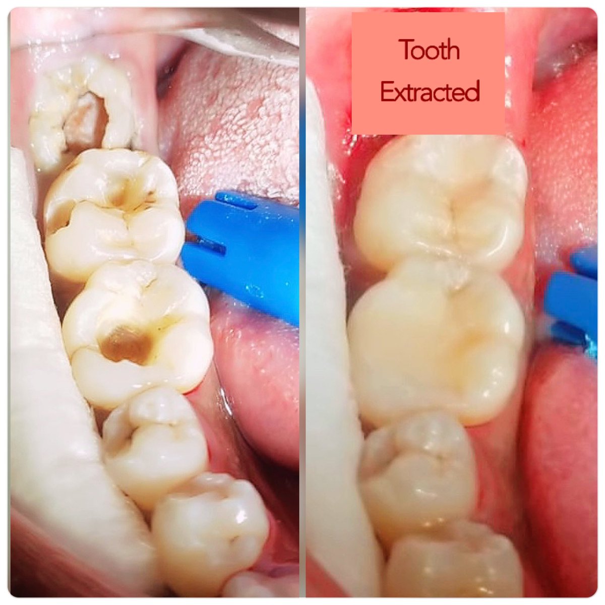 Cavities, gum issues, missing teeth? What's making you chew using only one side😰@Arrow_Dental ✔️TSC and Disciplined Forces schemes accepted at Thika branch. Southern Bypass Samidoh Kanjo Peter Tosh Jadon Sancho Reece James NHIF Nairobi Thiago Juja Dasani Ezra Chiloba Kanjo