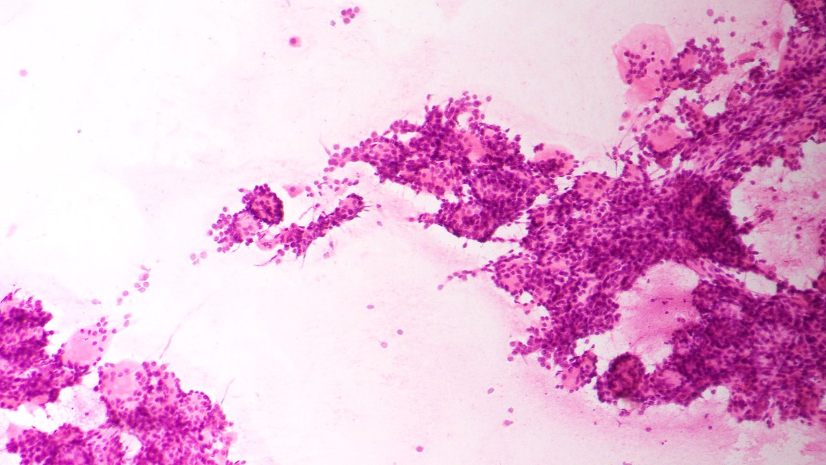 ROSE on a transthoracic FNA in a patient with multiple lung nodules and a history. What is that history?