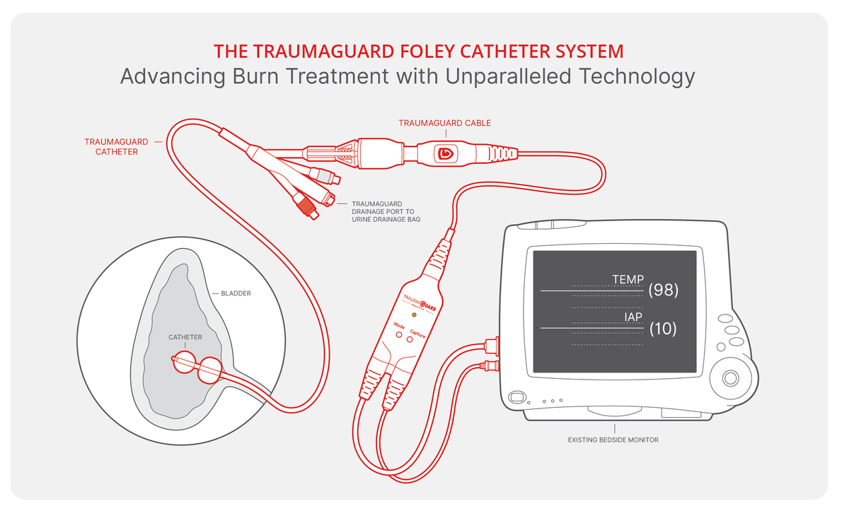 SentinelMedT's tweet photo. Are you accurately measuring Intra-Abdominal Pressure (IAP) in your severe #BurnPatients?  

Traditional transducer systems can often fall short, but with the TraumaGuard System, you get an FDA-cleared,  real-time #IAP monitoring, accurate to +/- 3 mmHg. 

It's time to elevate patient care with the TraumaGuard System. If you're interested, contact our team at: https://t.co/s4rGXlcAyg 

#Healthcare #MedTwitter #MedTech