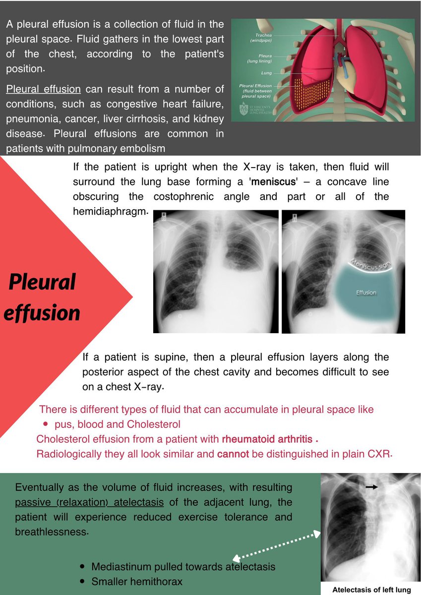MineRadiology's tweet image. Pleural effusion❤️🖤🤍💚
#X_ray #Pleural_effusion #Radiology #Radiographer #Radiologist #Technologist #Imaging