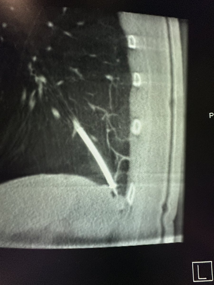 Bhadra & Condra CBCT Bronchoscopy tweet media