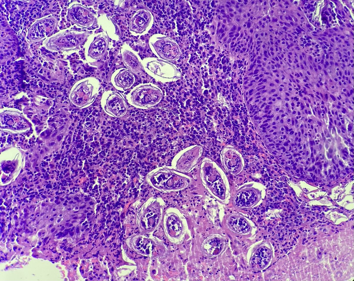 AngelNazco's tweet photo. Lesión vesical. Varón, 17 años, procedente de África.

Bladder injury. Male, 17 years old, from Africa. https://t.co/537CjDhP6k