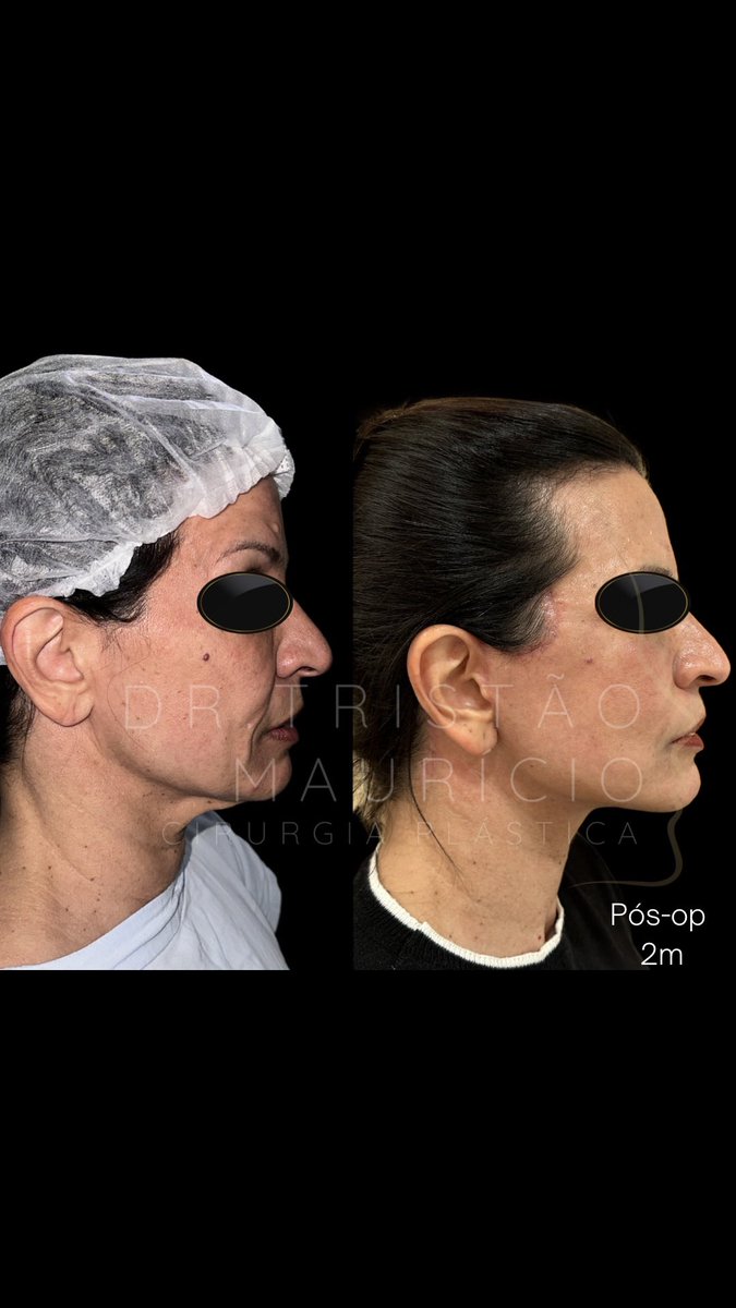 plasticatristao's tweet image. Paciente feminina, 54 anos, pós operatório recente de DEEP PLANE FACELIFT e DEEP NECK LIFT: o objetivo da abordagem  cirúrgica através desta técnica é reposicionar os tecidos musculares da face e pescoço. #deepplanefacelift #deepneck #deepnecklift #facelift #liftfacial #lift